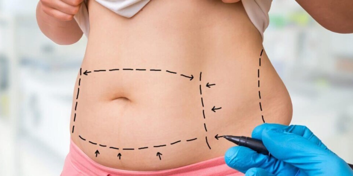 Different Types of Liposuction Dubai Techniques Explained