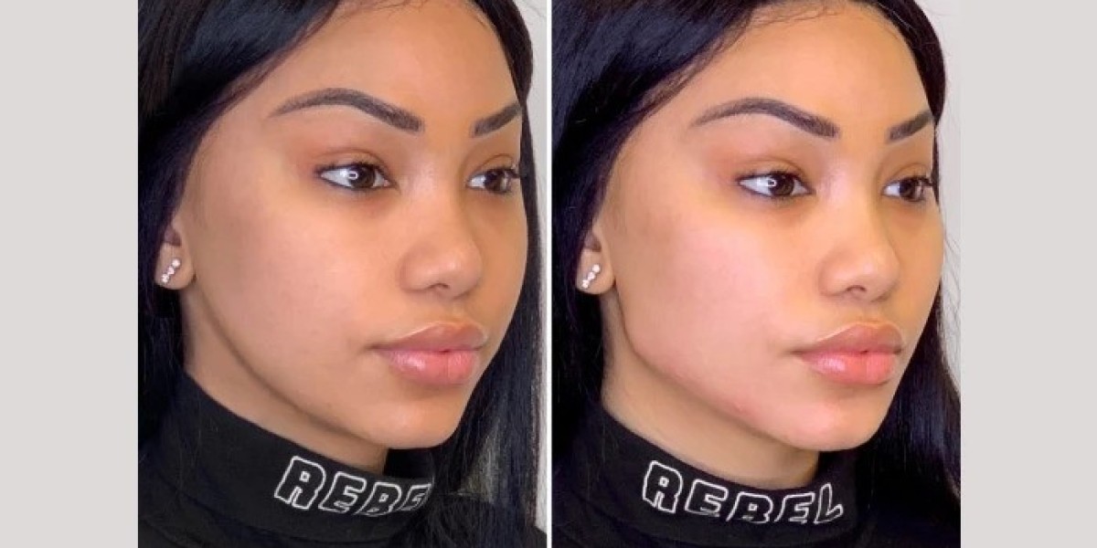 Best Plastic Surgeon in Dubai for Thread Lift Expert Anti Aging