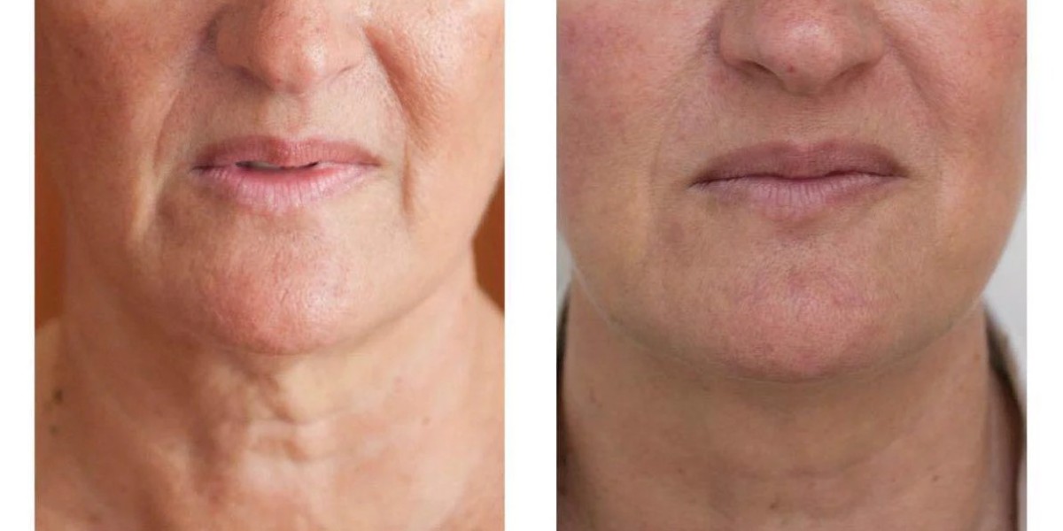 Profhilo at The Medispa: Advanced Skin Booster for Natural, Youthful Radiance