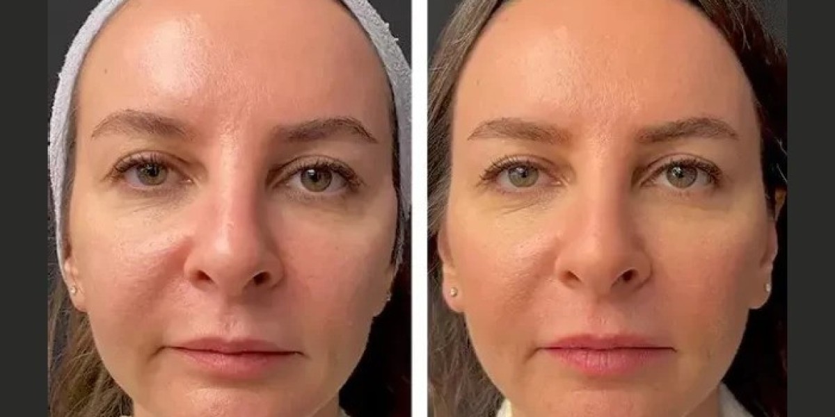 How Many Sessions Are Required for Mesotherapy Treatments in Dubai?