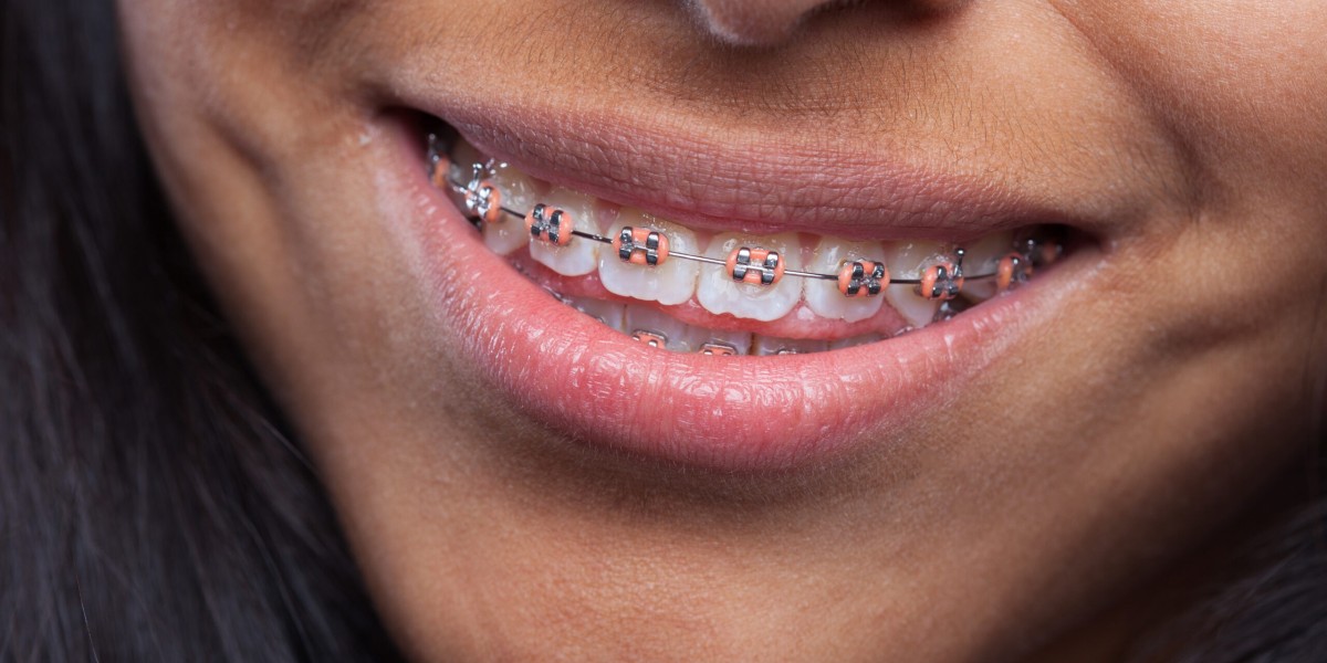 Dental Braces in Dubai for Improving Bite and Jaw Alignment
