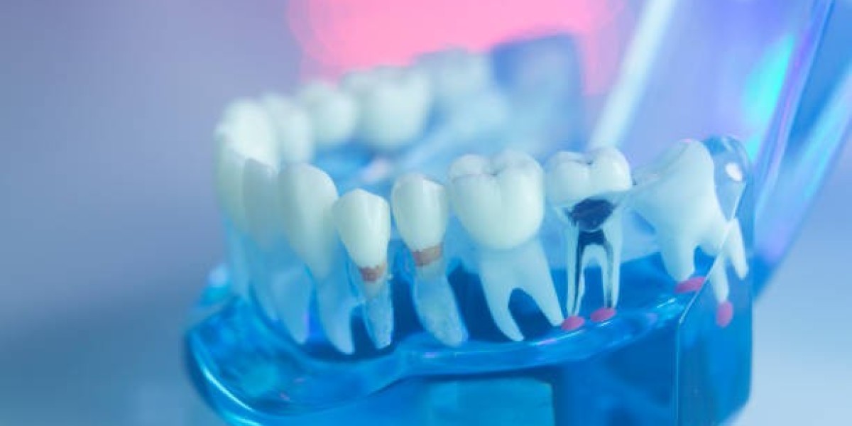 Root Canal Treatment in Islamabad: Protect Your Smile from Infection